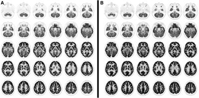 Case report: Post-COVID new-onset neurocognitive decline with bilateral mesial-temporal hypometabolism in two previously healthy sisters